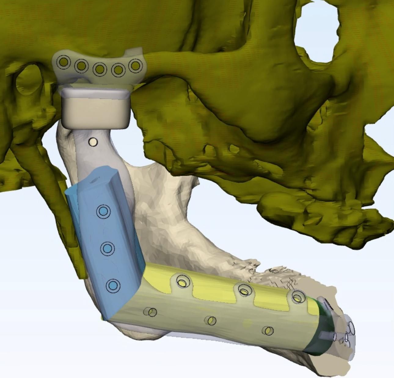 Total TMJ Replacement